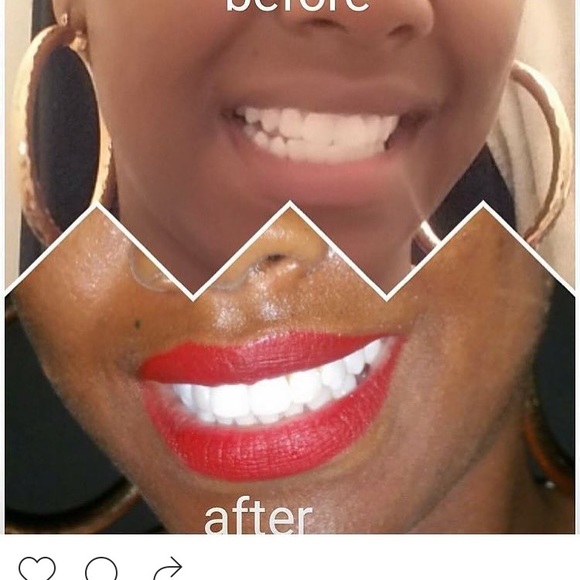 Teeth whitening kits - Picture 3 of 5